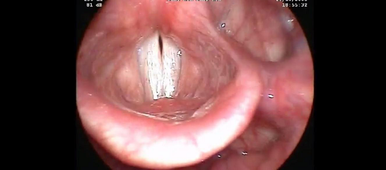 Vidéo de l’examen ORL « stroboscopie » de l’affrontement normale des plis vocaux Vidéo de l’examen ORL « stroboscopie » de l’affrontement normale des plis vocaux