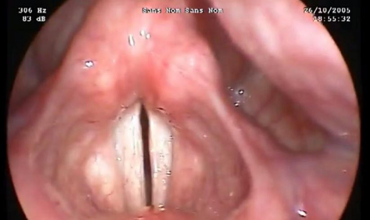 Vidéo de l’examen ORL « stroboscopie » d’un patient qui présente une paralysie récurentielle Vidéo de l’examen ORL « stroboscopie » d’un patient qui présente une paralysie récurentielle