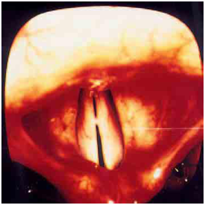 laryngite aigue laryngite aigue